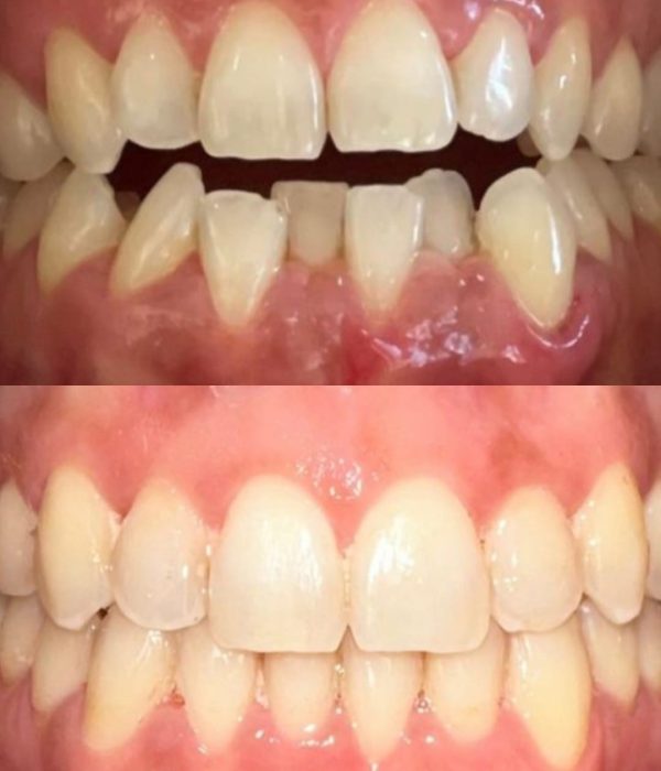 before and after 2