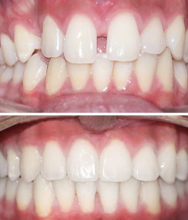 before and after 3
