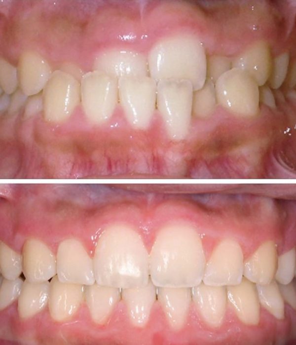 before and after 4