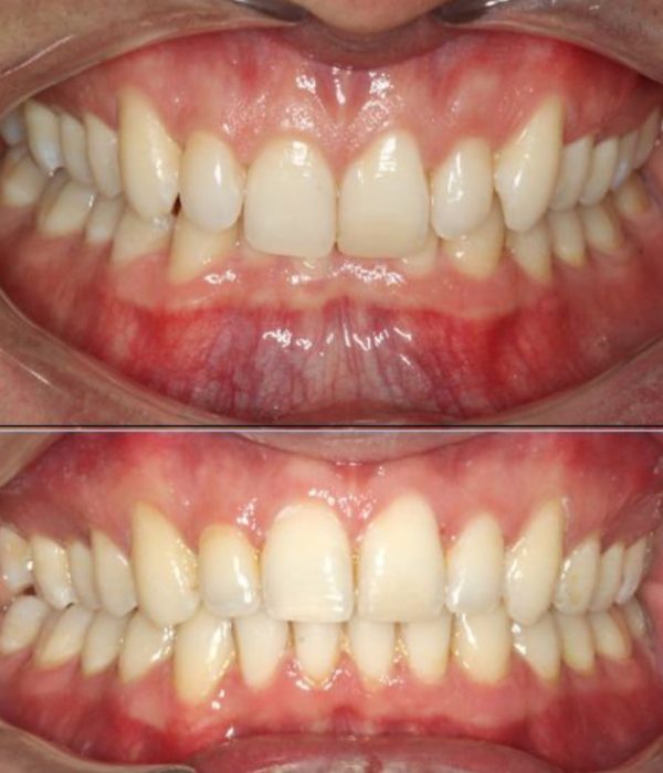 before and after