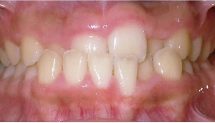Cross Bite